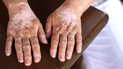 Bệnh bạch biến. Bệnh bạch biến là tình trạng tế bào sinh sắc tố ở da bị phá hủy khiến da mất đi lớp sắc tố melamin, gây nên tình trạng vùng da bị mất sắc tố chuyển màu trắng, có những đốm nâu xen kẽ, lông hoặc tóc trên vùng da bị bạch biến cũng chuyển màu trắng.