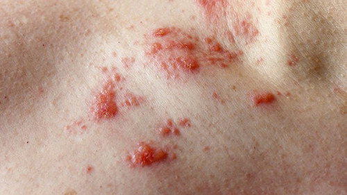 Ngứa vì Poison Ivy. Ngứa vì Poison Ivy là tình trạng ngứa bắt nguồn từ việc tiếp xúc với urushiol trong cây sồi độc. Khi urushiol ngấm sâu, da trở nên phồng rộp và ngứa ngáy khiến bạn phải gãi làm vết trầy xước lan rộng gây hiểu lầm tình trạng có thể lây lan.