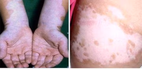 Bệnh bạch biến không thể chữa khỏi song việc áp dụng các phương pháp điều trị góp phần khôi phục màu sắc cho các vị trí bị thương tổn. Sử dụng kem chống nắng cũng hết sức cần thiết bởi phơi nắng khiến tình trạng ngày càng tiến triển trầm trọng.