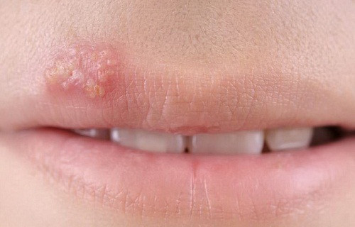 Rộp môi gây ra bởi virus herpes simplex (HSV). Có hai loại virus herpes simplex: HSV-1 và HSV-2. Cả hai loại vi-rút có thể gây ra môi và miệng lở loét và herpes sinh dục.