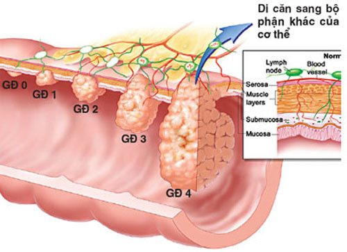 Ngoài yếu tố thời gian phát hiện bệnh, việc mắc ung thư bộ phận nào cũng quyết định đến khả năng phục hồi. Nếu như một số bộ phận phản ứng tích cực với quá trình điều trị thì hầu hết người mắc ung thư tuyến tụy không thể kéo dài sự sống.