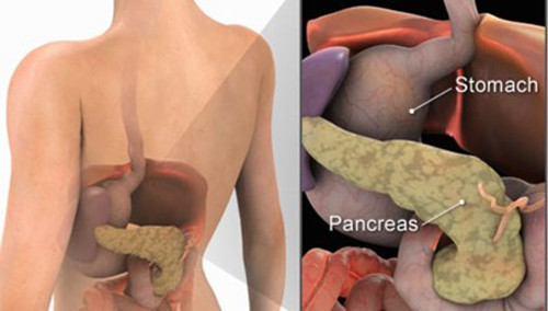 Hiện nguyên nhân thực sự gây ung thư tuyến tụy chưa được xác định và khá ít người có vấn đề về tuyến này. Tuy nhiên một khi tế bào trong tuyến tụy đột biến, chúng sẽ nhân rộng với tốc độ cực nhanh.