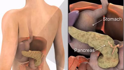 Hiện nguyên nhân thực sự gây ung thư tuyến tụy chưa được xác định và khá ít người có vấn đề về tuyến này. Tuy nhiên một khi tế bào trong tuyến tụy đột biến, chúng sẽ nhân rộng với tốc độ cực nhanh.