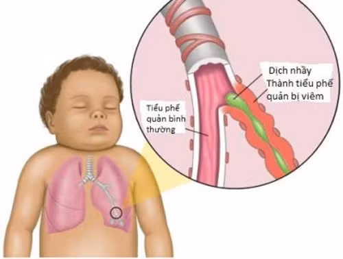 Một trong những nguyên nhân phổ biến sau những cơn ho kéo dài là chứng viêm phế quản. Viêm phế quản thường kéo theo ho kể cả khi đã khỏi bệnh. Nguyên nhân bởi siêu vi cảm, cúm có thể làm viêm đường thở trong nhiều tuần khiến các ống thở nhạy cảm hơn với những tác nhân gây ho bên ngoài. Chứng cảm, cúm cũng có thể khiến nước sau mũi tiếp tục chảy xuống họng một thời gian dài gây ra ho.