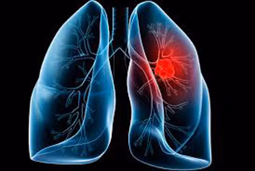 Ung thư phổi. Nếu mắc ung thư phổi, người bệnh có thể ho kéo dài tới hơn 8 tuần. Chuyên gia sức khỏe khuyến cáo tuyệt đối không nên bỏ qua dấu hiệu ho kéo dài kết hợp giảm cân, ho rau máu, mệt mỏi và đau tức ngực bởi tỷ lệ sống sau 5 năm mắc bệnh của ung thư phổi khá thấp, chỉ 17%.