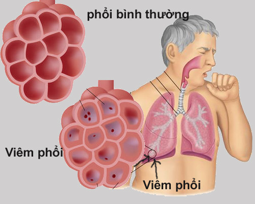 Nghiêm trọng hơn viêm phế quản, mắc chứng viêm phổi khiến cơ thể tiết đờm có màu, thậm chí có vệt máu trong đờm. Người bệnh cũng có thể bị sốt, mệt mỏi toàn thân, khó thở, ớn lạnh và bắt buộc phải được điều trị bằng kháng sinh.