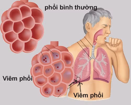 Nghiêm trọng hơn viêm phế quản, mắc chứng viêm phổi khiến cơ thể tiết đờm có màu, thậm chí có vệt máu trong đờm. Người bệnh cũng có thể bị sốt, mệt mỏi toàn thân, khó thở, ớn lạnh và bắt buộc phải được điều trị bằng kháng sinh.