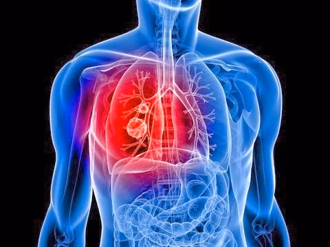 Tắc nghẽn phổi mạn tính. Tắc nghẽn phổi mạn tính (COPD) cũng là một trong những nguyên nhân gây ho nghiêm trọng và kéo dài. Ngoài ho, COPD còn khiến người bệnh gặp khó khăn trong quá trình hô hấp. Bệnh thường “hỏi thăm” đối tượng có thói quen hút thuốc lá, tiếp xúc nhiều khói bụi.