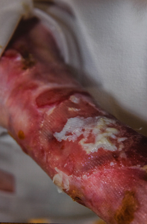 Để bảo vệ làn da, chàng thanh niên phải dành 4 giờ mỗi ngày dùng băng quấn quanh mình. Không chỉ chịu đau đớn triền miên từ phần da bên ngoài, James thi thoảng còn cảm thấy đau mắt và cổ họng.