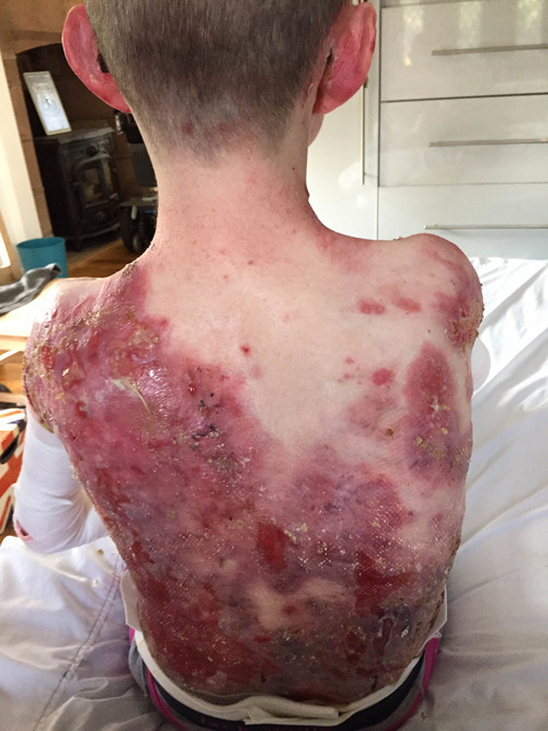 Về tình trạng của mình, James chia sẻ: “Đôi khi tôi cảm thấy mắt mình như bị rộp và cả ngày hôm đó tôi phải ở trong nhà bởi không thể nhìn thấy vật gì. Lúc đó thực sự tồi tệ”.