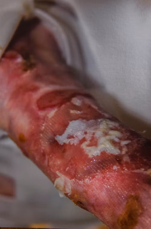 Để bảo vệ làn da, chàng thanh niên phải dành 4 giờ mỗi ngày dùng băng quấn quanh mình. Không chỉ chịu đau đớn triền miên từ phần da bên ngoài, James thi thoảng còn cảm thấy đau mắt và cổ họng.