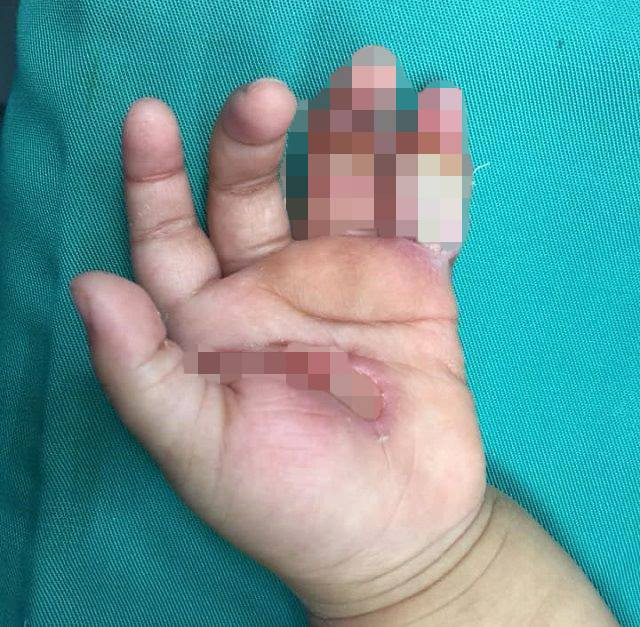 Be 1 tuoi bi dien giat khien ban tay bong nang