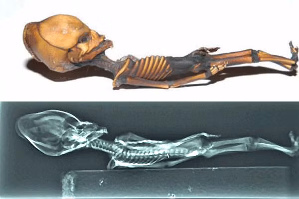 Nhóm nghiên cứu cũng tìm thấy bằng chứng chứng minh xác ướp ỏ Atacama là bé gái sơ sinh có nhiều đột biến gene gắn liền với chứng lùn, vẹo cột sống và nhiều bất thường ở hệ cơ và xương.