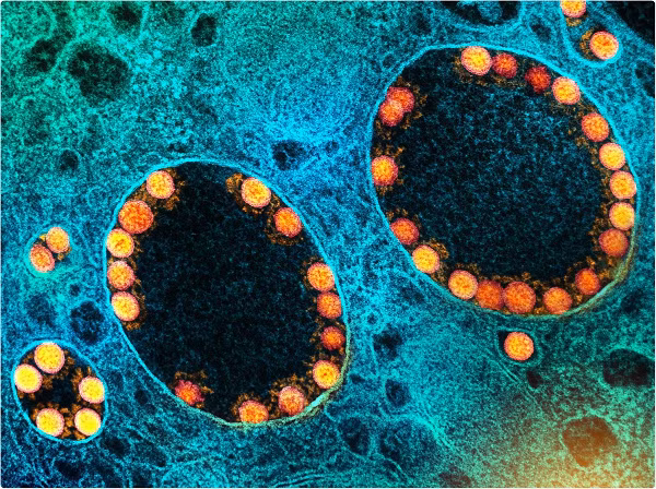 Nhà khoa học này cho rằng kịch bản lây truyền virus như vậy có thể xảy ra trong trường hợp có con dơi bị nhiễm bệnh khi ăn phải trái cây bị một người mắc bệnh cắn vào và bỏ lại.
