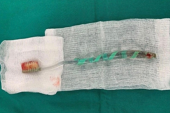 Nhieu nguoi nhap vien vi nuot ban chai danh rang: Bac si khuyen cao gi?-Hinh-2