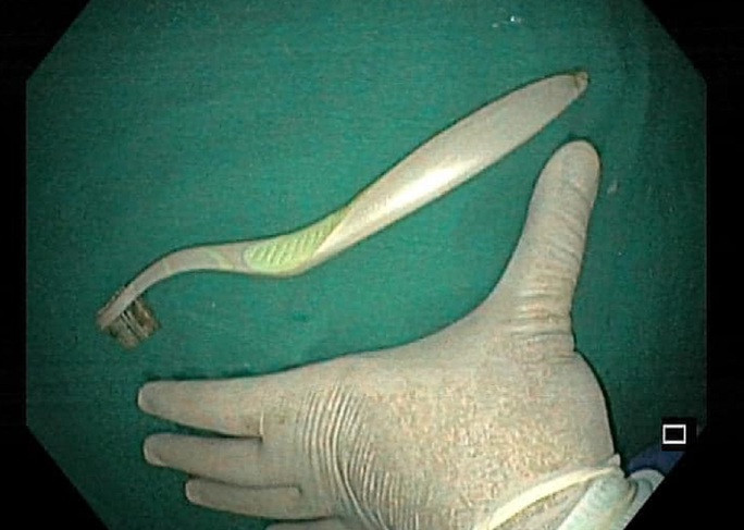 Nhieu nguoi nhap vien vi nuot ban chai danh rang: Bac si khuyen cao gi?