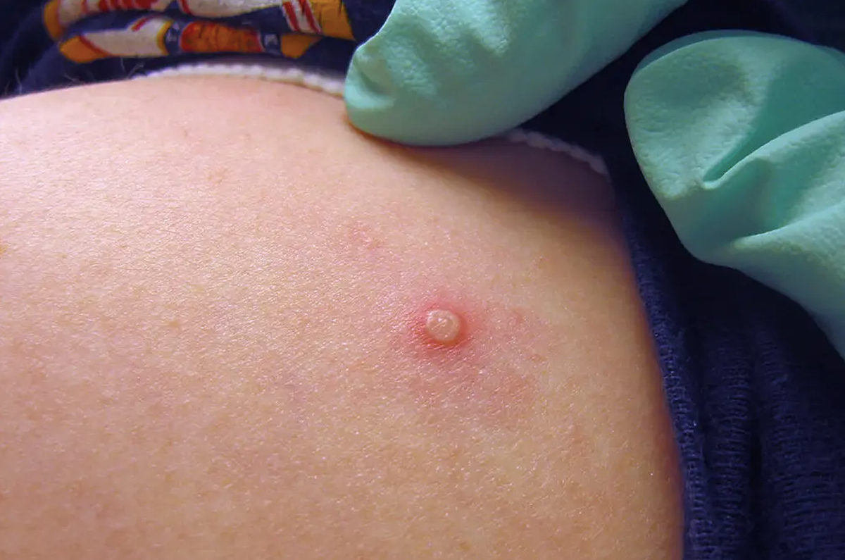 Nghi nhiem dau mua khi, nen lam gi?