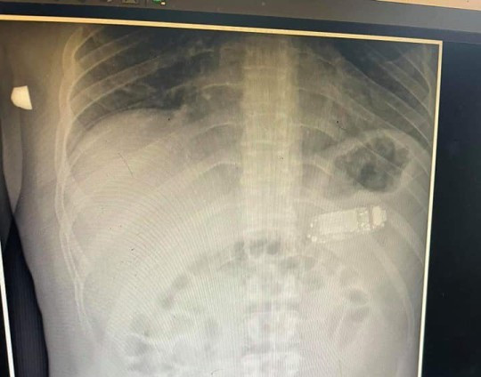 Suyt mat mang vi nuot chung dien thoai di dong vao bung-Hinh-2