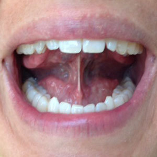 Bài 4. Ấn lưỡi trên vòm miệng. Đặt lưỡi lên vòm miệng và ấn lưỡi vào vòm miệng càng mạnh càng tốt. Lặp đi lặp lại 20 lần để có thể ngăn chặn ngủ ngáy.