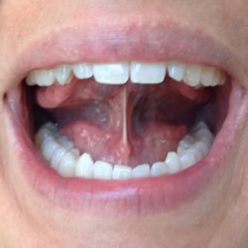 Bài 4. Ấn lưỡi trên vòm miệng. Đặt lưỡi lên vòm miệng và ấn lưỡi vào vòm miệng càng mạnh càng tốt. Lặp đi lặp lại 20 lần để có thể ngăn chặn ngủ ngáy.