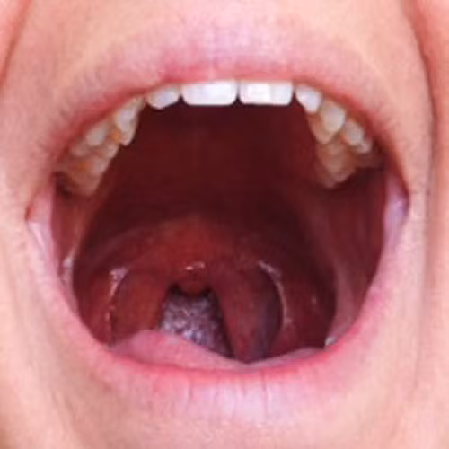 Bài 5. Nói Ahhhhhhhh. Bài tập này rất dễ dàng. Giống như bạn đi khám răng, há vòm miệng rộng và nói chữ A. Lặp đi lặp lại động tác này.