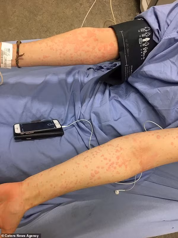 Di ung mua dong: benh la khien co gai tre co the chet vi an kem-Hinh-3