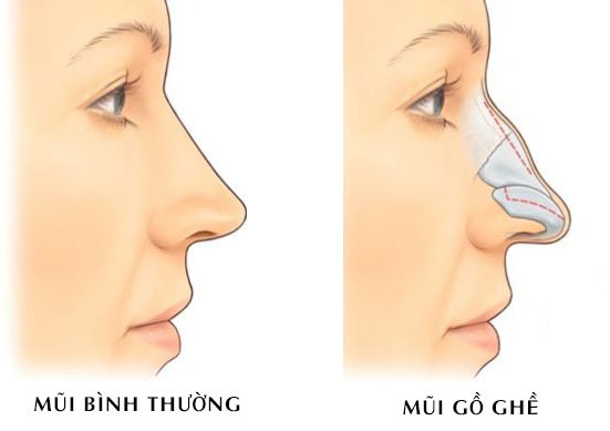  Tướng mũi gồ. Sụn và xương mũi nhô lên tạo thành đường sóng gồ ghề. Tướng mũi gồ được chia làm hai loại. Một là mũi gồ đơn thuần; hai là mũi gồ hình yên ngựa (đầu mũi dài, nhọn và quặp xuống. 