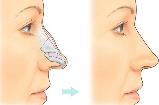  Tướng mũi gãy. Tương mũi gãy tượng trưng cho việc tài lộc, tình duyên, sự nghiệp gặp nhiều trắc trở. Phụ nữ sở hữu tướng mũi này tính cách thất thường. Thậm chí có người miệng thì thơn thớt nói cười nhưng thực chất đang ngấm ngầm đâm chọc sau lưng. 