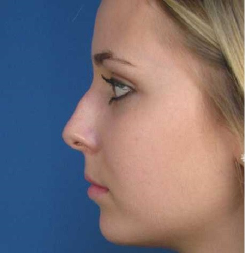 Sống mũi đại diện cho sự phát triển. Do đó, sống mũi gãy tượng trưng cho con đường công danh trắc trở, cuộc sống gặp nhiều khó khăn, dễ lâm vào cảnh ăn bữa nay lo bữa mai.