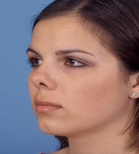  Tướng mũi hếch. Phần sống mũi và đầu mũi ngắn, không bao trùm được toàn bộ lỗ mũi, khiến lộ mũi lộ ra gọi là mũi hếch. Tướng mũi này được coi là tướng xấu.