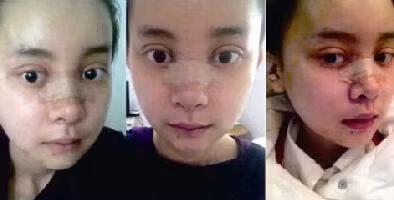 Sau 20 ngày phẫu thuật, khuôn mặt của cô gái đã bớt sưng hơn rất nhiều và đã rõ nét.