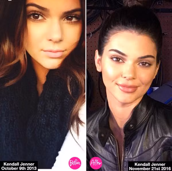 Theo HollywoodLife.com, bác sĩ phẫu thuật thẩm mỹ John Zannis cho rằng trông Kendall Jenner có sự thay đổi vẻ ngoài và những bức ảnh gần đây của cô cho thấy người mẫu trẻ đã bơm môi. (Ảnh: Hollywoodlife)