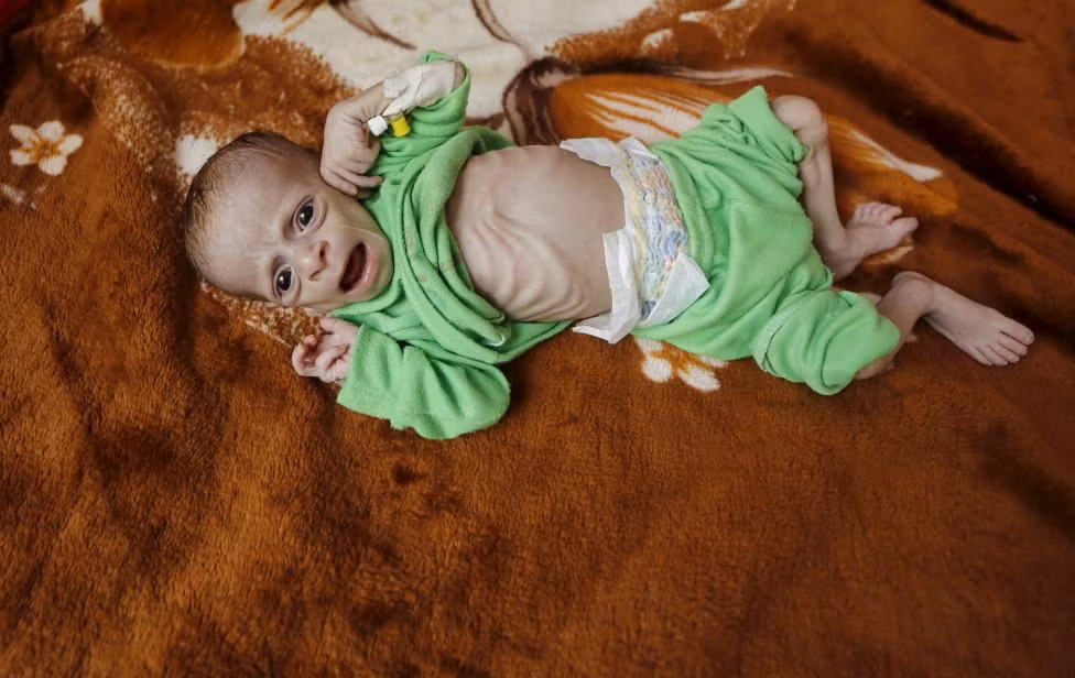 Một em bé suy dinh dưỡng nằm trên giường trong bệnh viện ở thủ đô Sanaa, Yemen, ngày 28/7.