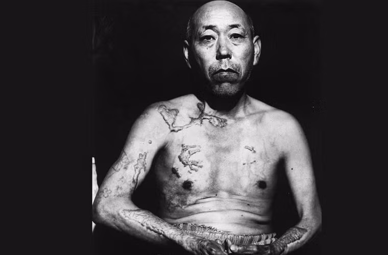 Nạn nhân may mắn sống sót sau sự kiện Mỹ thả bom nguyên tử xuống thành phố Hiroshima, Nhật Bản năm 1945 Jinpe Teravama với nhiều vết sẹo và bỏng khắp cơ thể. Ảnh chụp hồi tháng 6/1947.