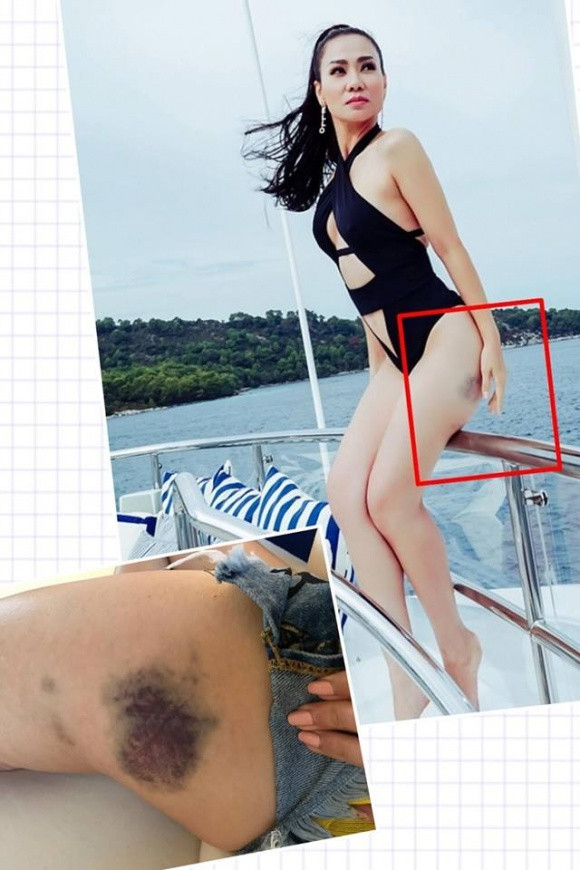 Ca sĩ Thu Minh lộ rõ vết bầm tím ở đùi khi diện áo tắm.