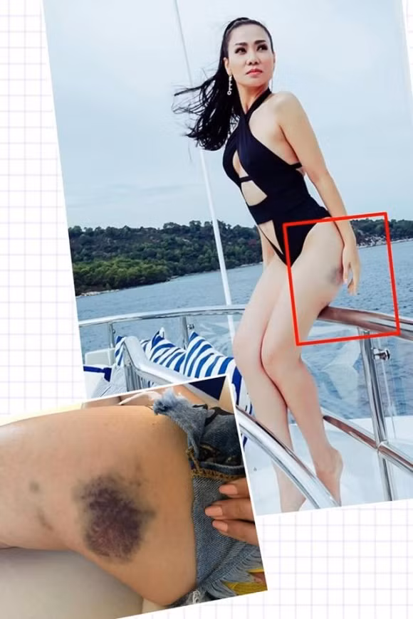Ca sĩ Thu Minh lộ rõ vết bầm tím ở đùi khi diện áo tắm.