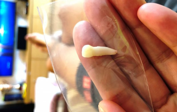 Chiếc răng của Ricky được nhà trường “bàn giao” cho gia đình.