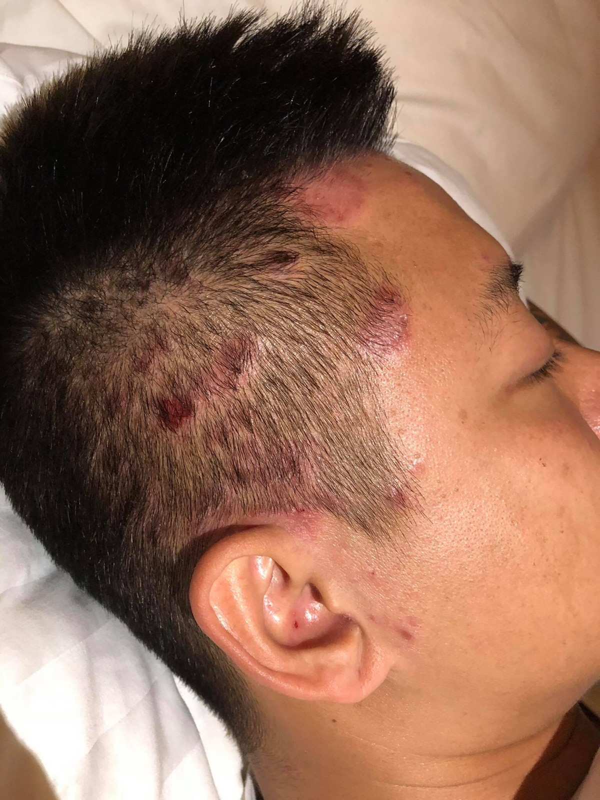 Nam ca sĩ bị nổi từng mảng mẩn đỏ khắp cơ thể.