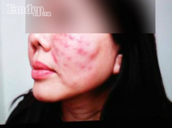 Một nạn nhân biến chứng nặng do uống corticoid theo hướng dẫn của spa kém chất lượng bác sĩ Hóa từng tiếp nhận. Ảnh: BSCC