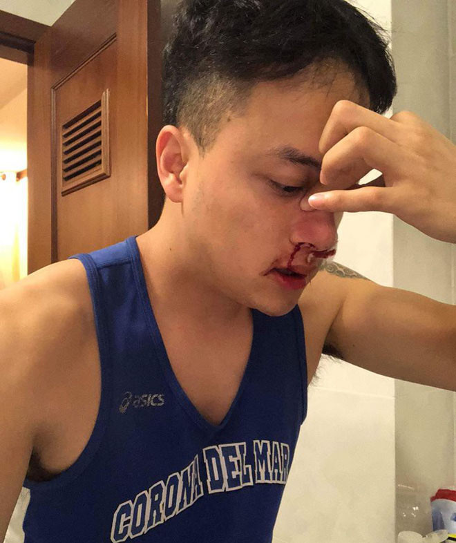 Cao Thái Sơn nhập viện khẩn cấp lúc nửa đêm vì bị chảy máu mũi không ngừng.