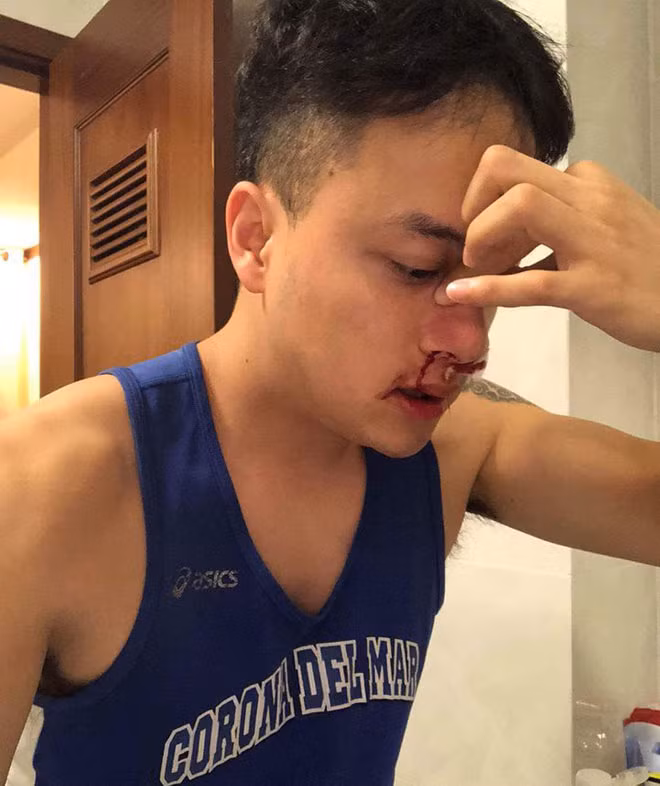 Cao Thái Sơn nhập viện khẩn cấp lúc nửa đêm vì bị chảy máu mũi không ngừng.