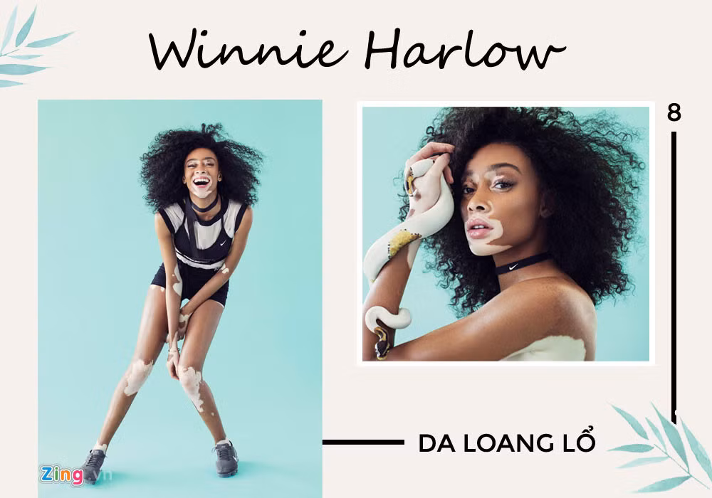 Winnie Harlow được biết đến như "chân dài bạch biến". Cô bắt đầu nổi tiếng khi tham gia America's Next Top Model năm 2014. Dù sớm bị loại, cô gái 23 tuổi vẫn kịp để lại ấn tượng trong lòng khán giả và làng mốt nói chung. Nhiều người nhận định chính làn da loang lổ đã mang đến cho 9X một sự nghiệp thành công.