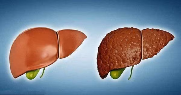 Gan không có dây thần kinh ngoại biên, khi gặp các vấn đề về gan, xơ cứng, thậm chí ung thư gan người bệnh sẽ khó cảm nhận sự thay đổi bất thường ở giai đoạn đầu do không có dấu hiệu đau rõ ràng. Chỉ khi tế bào ung thư lan sang các vùng xung quanh mới gây cảm giác đau đớn rõ rệt. Điều này ảnh hưởng đến hiệu quả điều trị bệnh. (Ảnh minh họa)