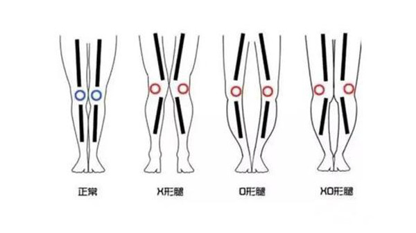 Thực tế, nhiều cô gái có đôi chân không thẳng dạng chữ O hoặc chữ X như hình. Ngoài việc hạn chế mặc quần đùi và quần bó, bốt cũng là phụ kiện cần lưu ý.