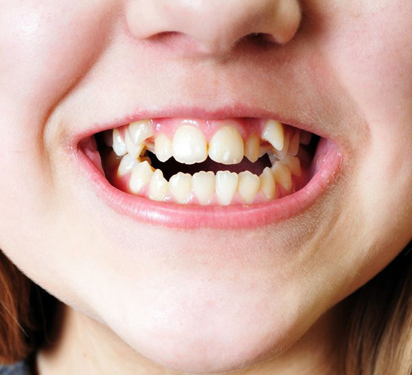 Gây hôi miệng: Hôi miệng là kết quả của sự phát triển quá mức vi khuẩn trong miệng. Tình trạng khô nước bọt ở miệng sẽ tạo điều kiện cho vi khuẩn phát triển. Điều này dễ xảy ra khi khoang miệng bị khô do thở bằng miệng. Ngoài ra, việc hít một số chất gây dị ứng và vi khuẩn thông qua miệng cũng có thể làm tăng chứng hôi miệng.