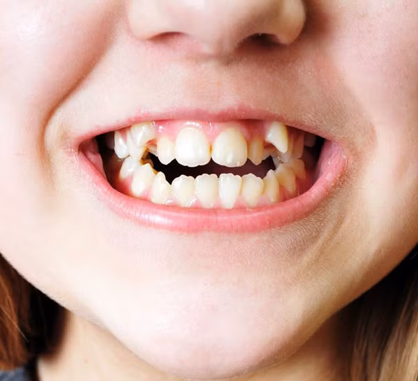 Gây hôi miệng: Hôi miệng là kết quả của sự phát triển quá mức vi khuẩn trong miệng. Tình trạng khô nước bọt ở miệng sẽ tạo điều kiện cho vi khuẩn phát triển. Điều này dễ xảy ra khi khoang miệng bị khô do thở bằng miệng. Ngoài ra, việc hít một số chất gây dị ứng và vi khuẩn thông qua miệng cũng có thể làm tăng chứng hôi miệng.