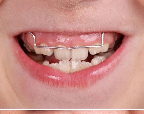 Khớp cắn kém, các vấn đề về răng. Bên cạnh việc khô miệng và sâu răng, thở bằng miệng còn gây ra một loạt các vấn đề liên quan đến răng và hàm. Chẳng hạn, răng khấp khểnh, khớp cắn xấu, lệch lạc, cười hở lợi...