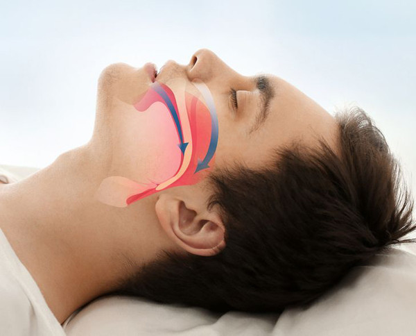 Ngưng thở khi ngủ là hiện tượng ngừng thở trong một khoảng thời gian nhất định khi ngủ. Hiện tượng này xảy ra do sự kích ứng lên hệ hô hấp, thường có triệu chứng ngáy to, thức dậy với miệng khô, mất ngủ, mệt mỏi vào ban ngày.