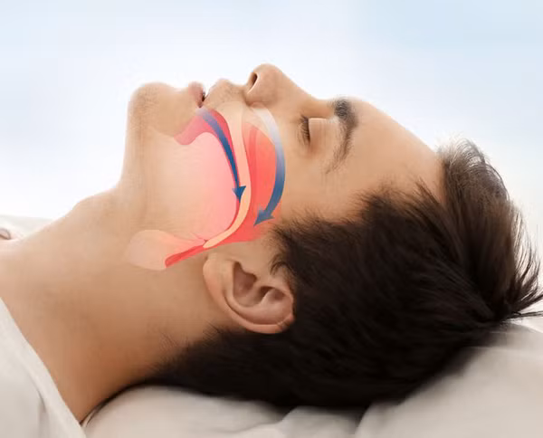 Ngưng thở khi ngủ là hiện tượng ngừng thở trong một khoảng thời gian nhất định khi ngủ. Hiện tượng này xảy ra do sự kích ứng lên hệ hô hấp, thường có triệu chứng ngáy to, thức dậy với miệng khô, mất ngủ, mệt mỏi vào ban ngày.