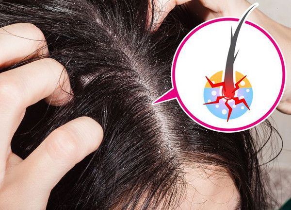 Gãi đầu quá mạnh. Gãi mạnh làm lớp biểu bì bị hỏng, nang tóc ảnh hưởng. Lời khuyên cho bạn là nên massage nhẹ nhàng trong quá trình gội. Thực hiện chế độ ăn lành mạnh, tăng cường bổ sung protein, vitamin A, D và E cũng có tác dụng cải thiện tình trạng.